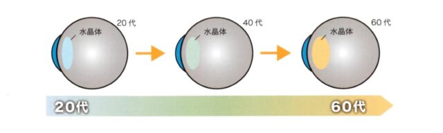 加齢による目の劣化と水晶体の黄変